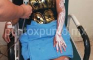 MUJER RESULTA LESIONADA EN FLAMAZO EN SU DOMICILIO